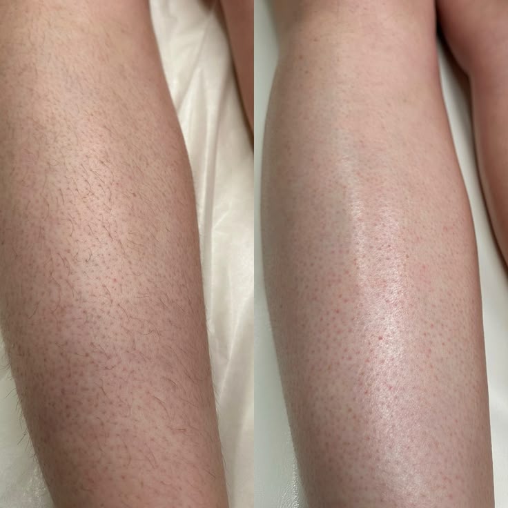 Lumi IPL Hair Removal