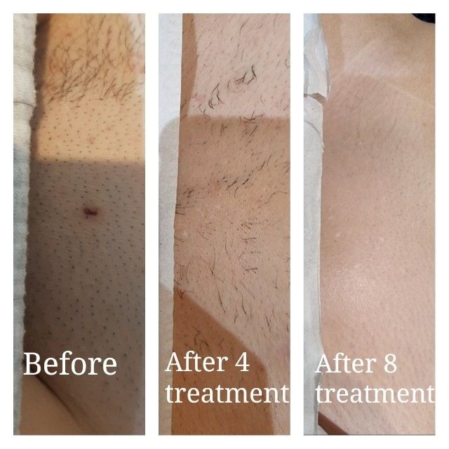 Lumi IPL Hair Removal