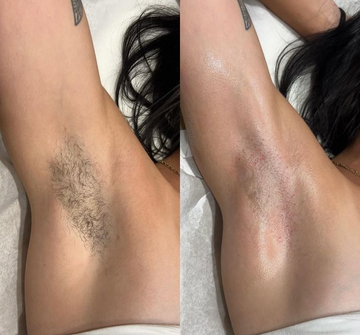 Lumi IPL Hair Removal