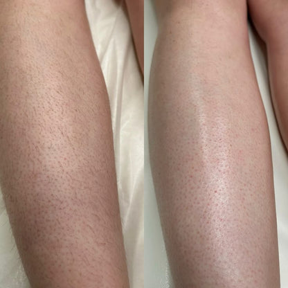 Lumi IPL Hair Removal