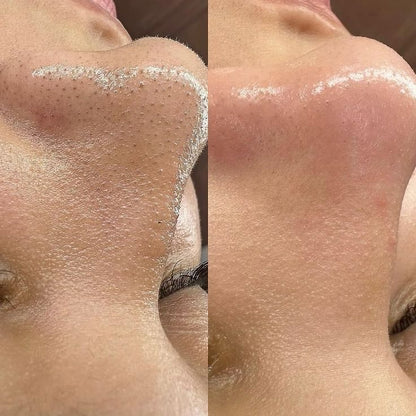 Lumi IPL Hair Removal