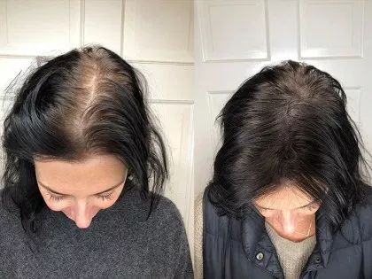 Hair Grower: Electric Scalp Massager