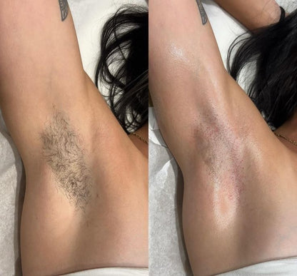 Lumi IPL Hair Removal